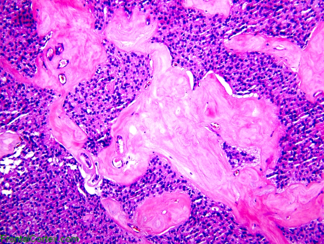 Myxopapillary ependymoma, H&E stain x 40